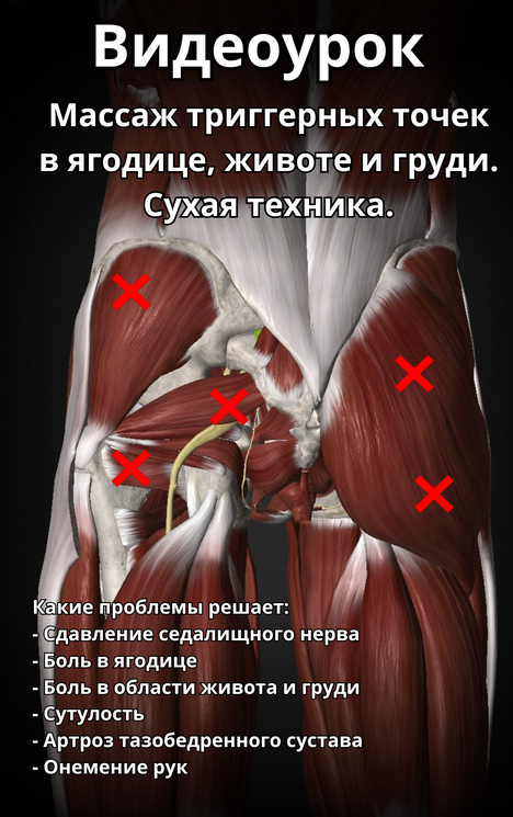 [Артем Пак] Массаж триггерных точек в ягодице, жив_0.png